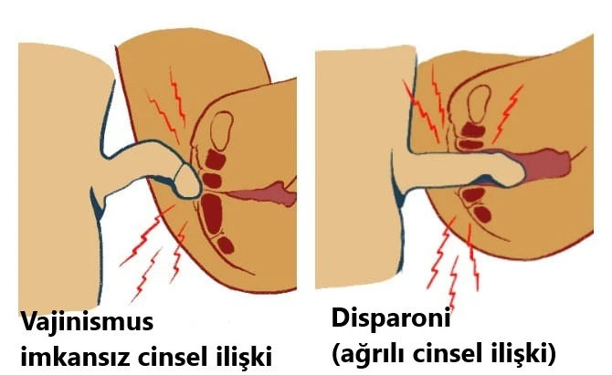 Vajinismus Nedir ?